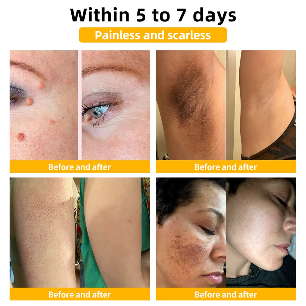 Tagaway - Effective Removal of Warts and Skin Growths