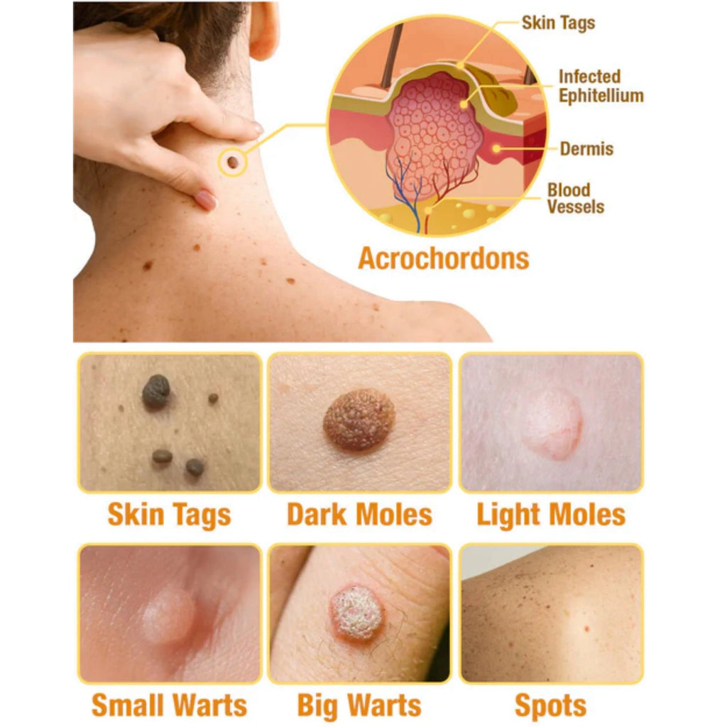 Tagaway - Effective Removal of Warts and Skin Growths